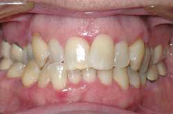 Carla-teeth-initial