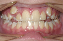 Annabelle-teeth-initial